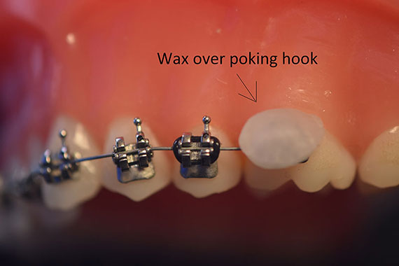 Wax on a poking wire, How to put wax on a poking wire to help ease  discomfort.
