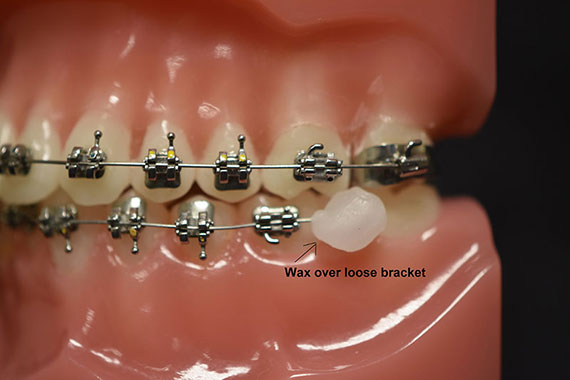 braces brackets with hooks