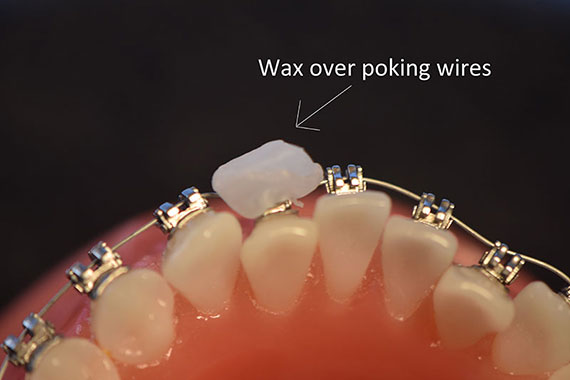 What to do when I have an orthodontic wire sticking out and poking