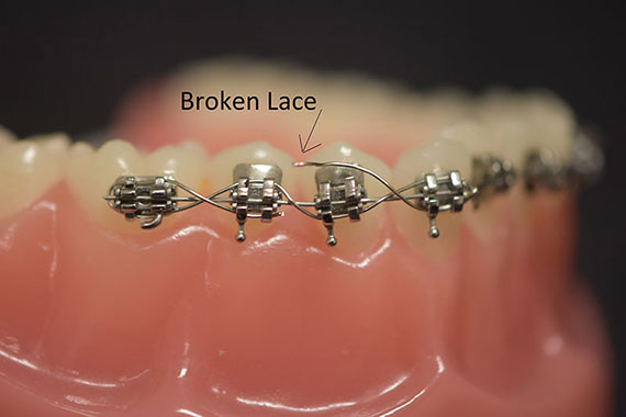 braces orthodontic poking ligature orthodontics