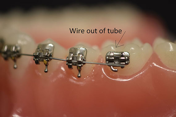 My Wire Came Loose and is Poking, What Do I Do? - Ask an Orthodontist.com