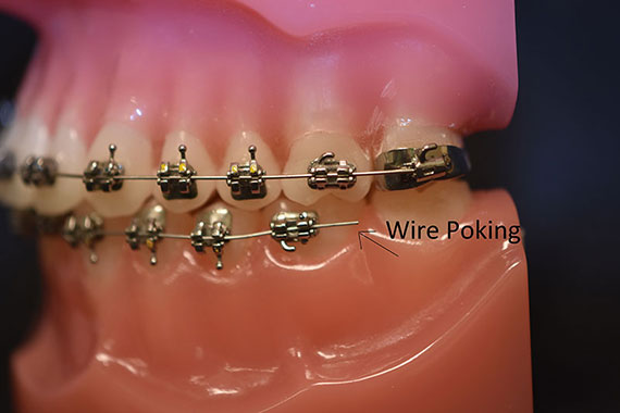 What Is A Poking Wire In Braces and Orthodontics? - ArchWired